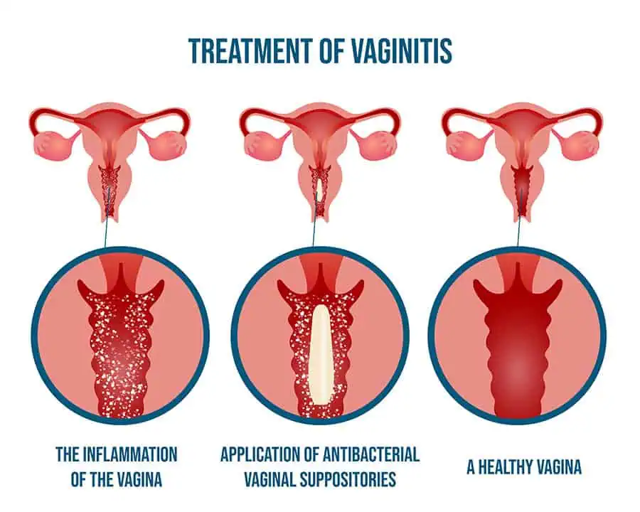 treatment of vaginitis
