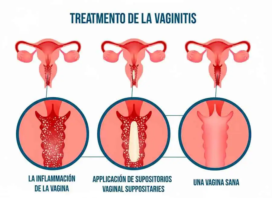Vaginitis